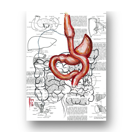 Marco de póster de anatomía: bypass gástrico del estómago 