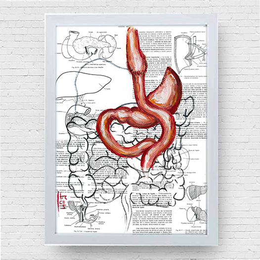 Marco de póster de anatomía: bypass gástrico del estómago 