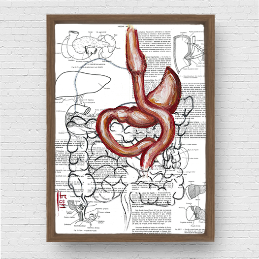 Marco de póster de anatomía: bypass gástrico del estómago 