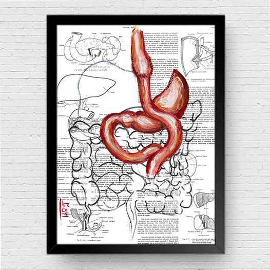 Marco de póster de anatomía: bypass gástrico del estómago 
