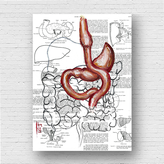 Marco de póster de anatomía: bypass gástrico del estómago 
