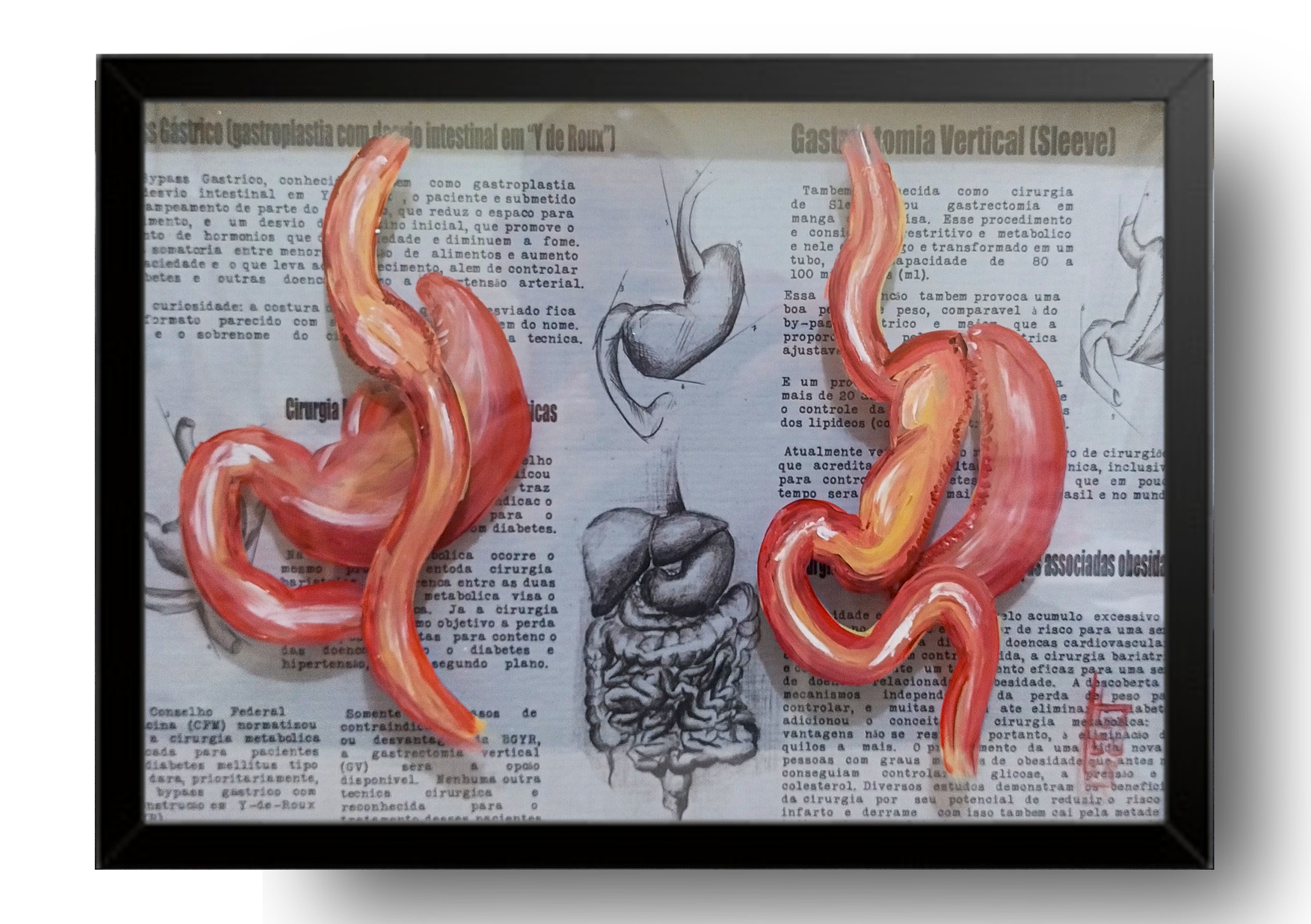 Cuadro Anatomía: Pintura original Cirugía bariátrica Bypass y manga 